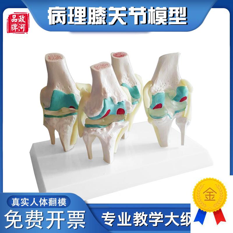 政河病理膝关节人体骨骼模型膝盖骨头病变K演示正骨关节医院学校