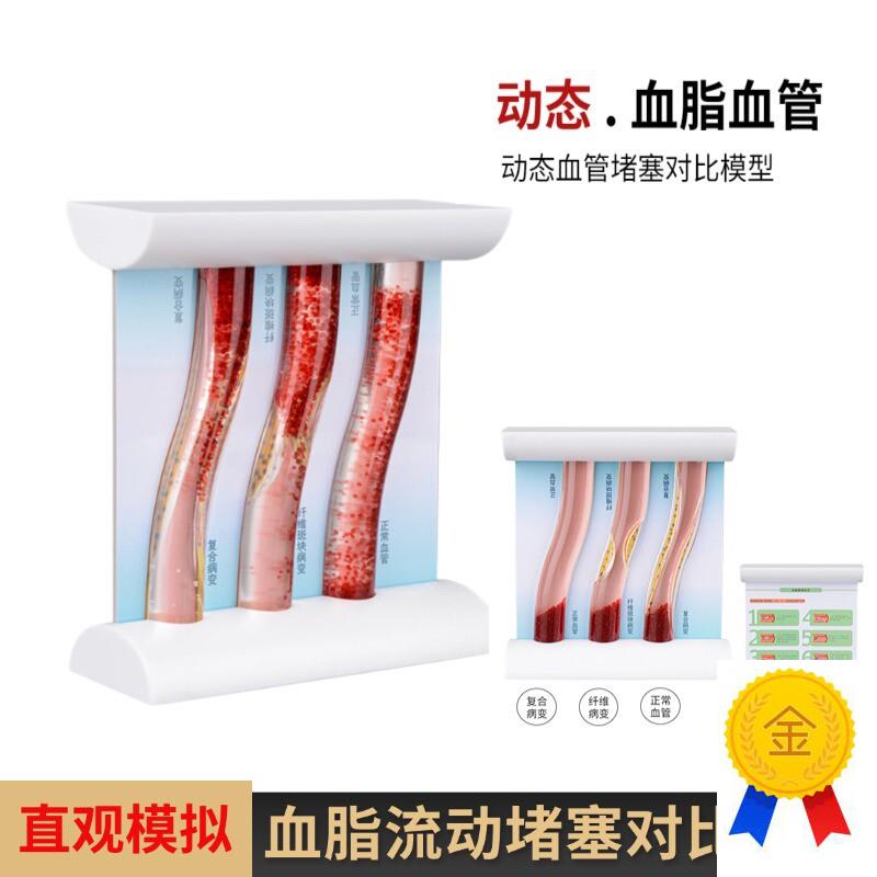 血管浓稠度堵塞对比人体血脂斑块血栓展示M模具仿真动态血管模型