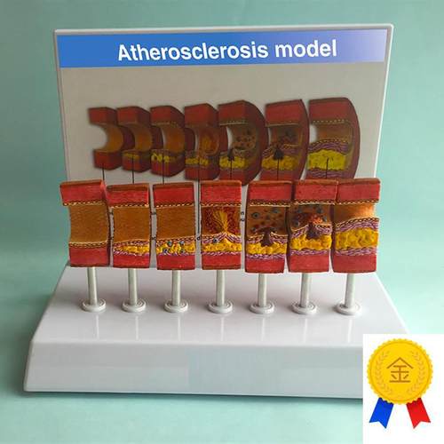 动脉粥样硬化模型血管血栓u栓塞模型动脉血管人体医用医学教学教