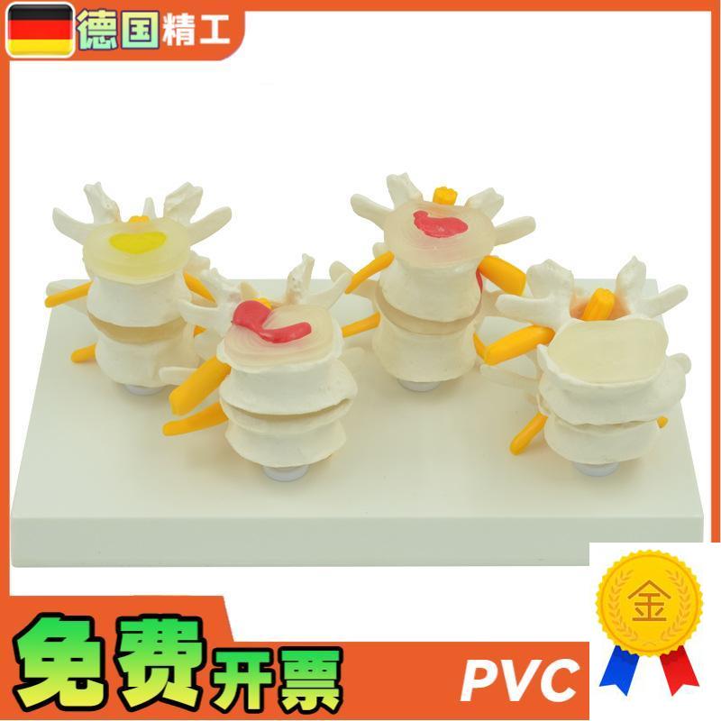 德国】4阶段病变腰椎模型人体骨I骼解剖椎体医学教学器材