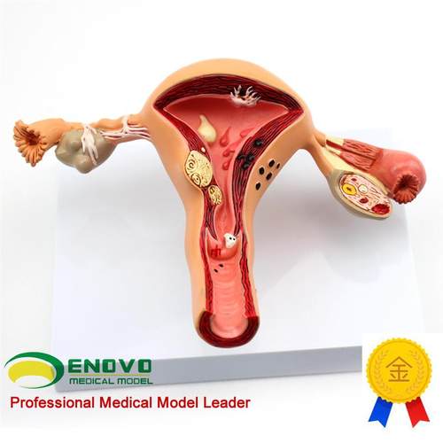 ENOVO颐f诺人体女性子宫卵巢模型子宫疾病生殖科妇产科医患沟通讲