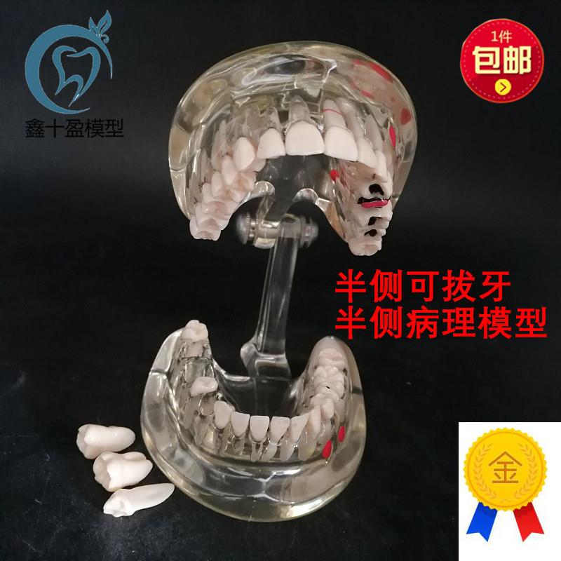 牙科牙齿模型g成人病理半侧可拔牙模型医患沟通口腔教学教具C3
