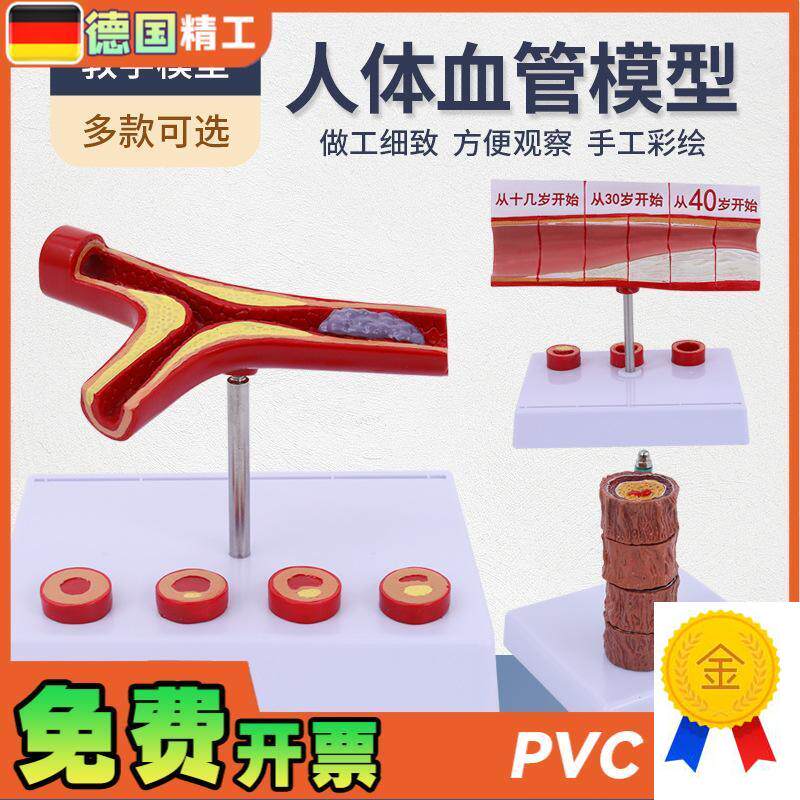 堵塞心血管模型血栓血q液浓度脂肪病理粥样硬化人体血管解剖模具