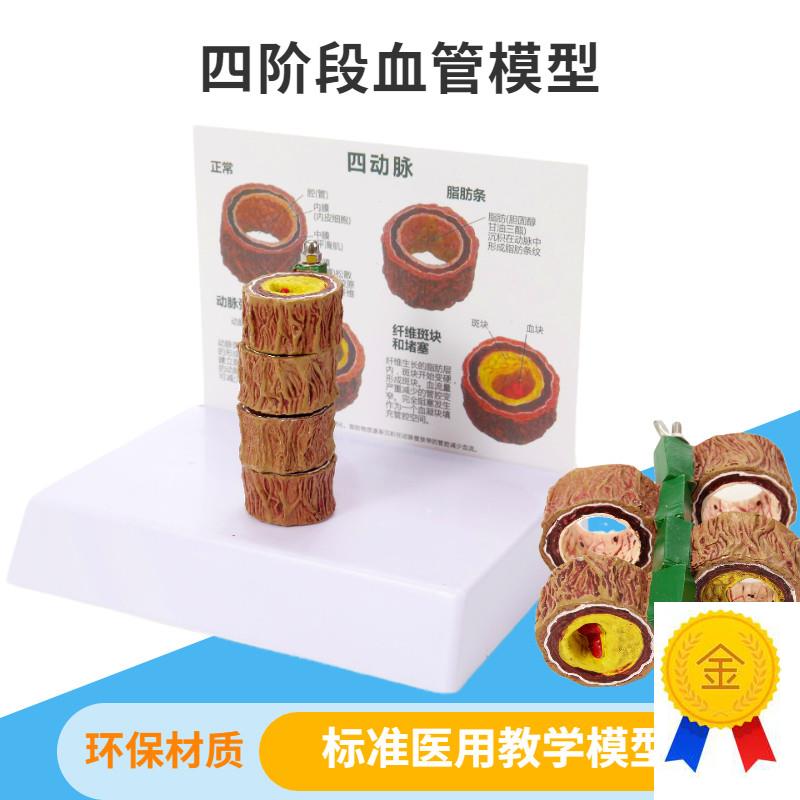 人体动脉粥样血管模型血栓病变模型四阶段心血管R模型示教内科玩
