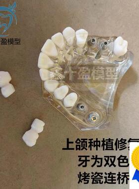 牙科种植模型2011上颌种植解说义齿修复烤瓷V连桥种植钉模型