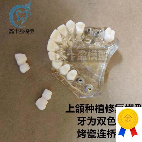 牙科种植模型2011上颌种植解说义齿修复烤瓷V连桥种植钉模型