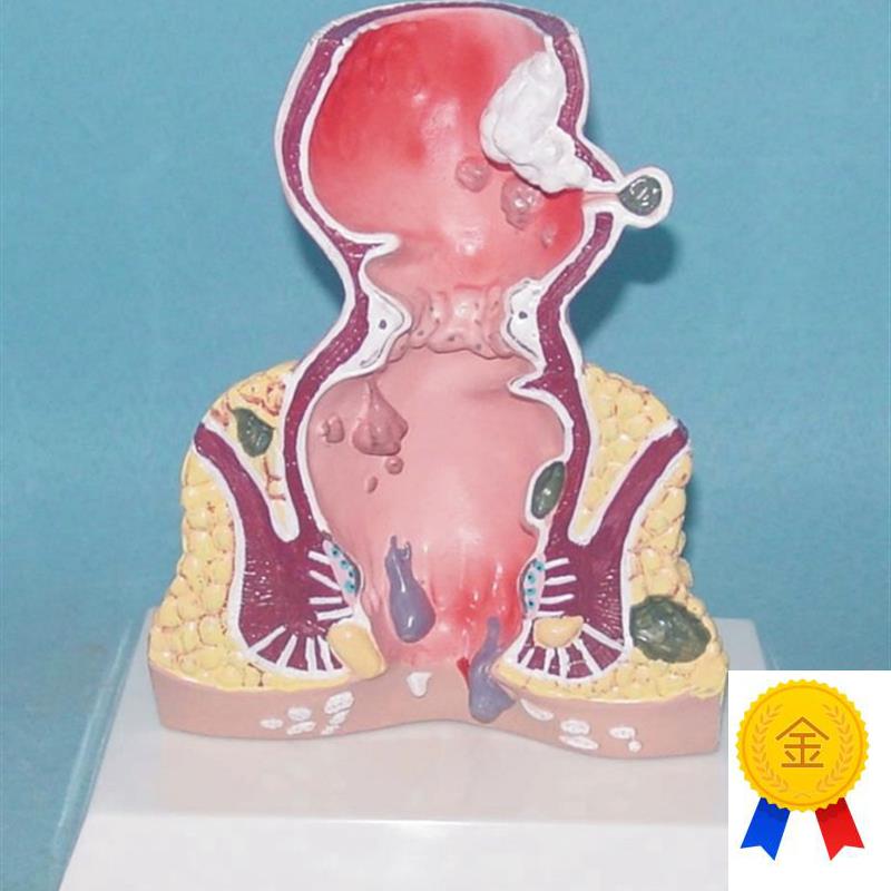 包邮人体直肠常见病解剖w模型器官肛门医用教学讲解展示