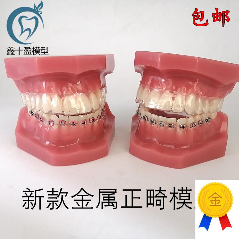 牙科口腔教学g模型隐形正畸矫正模型金属正畸模型口腔展示模型