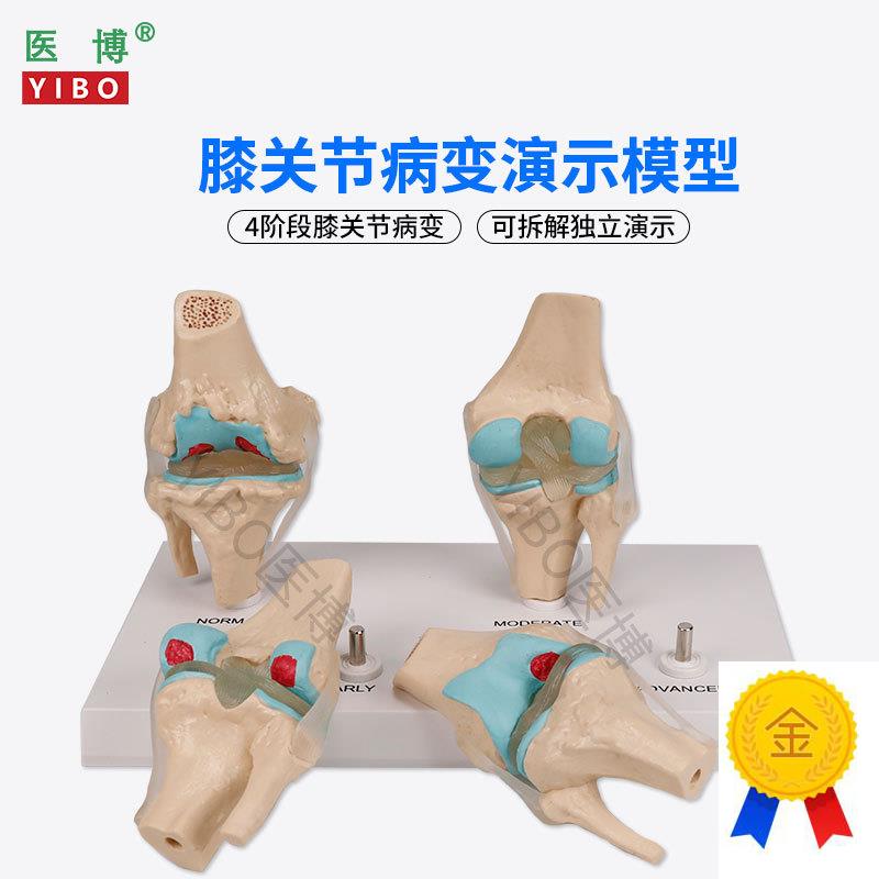 医博BIX-A3571膝关q节病变模型人体骨骼病变模型人体膝关节4阶段