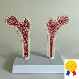 骨质疏松模型股骨头骨髓密度变化骨E科医药促销年龄段脊椎病理医