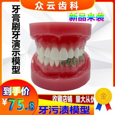 口腔牙科牙污渍模型牙科刷牙直播展示坏外购牙污V渍牙渍道具仿真