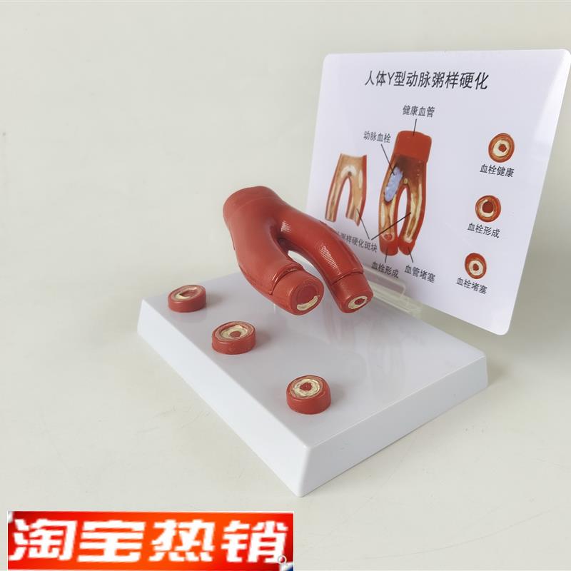 人体心脑血管动脉粥样硬化堵塞模型血栓血液脂肪病理解剖医学教具