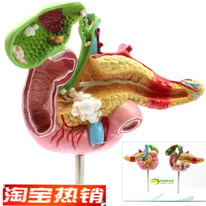 ENOVO颐诺医学胰腺十二指肠胆囊病理模型外科消化科系统模具肝胆