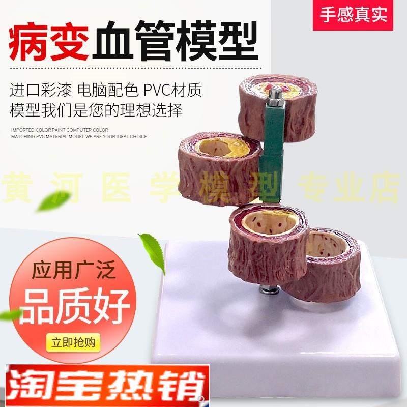 硬化支脉粥样血管模型 心血管动脉解剖模型 人体病态血管模型血栓