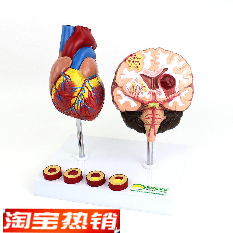 ENOVO颐诺 心脑血管疾病展示模型 高血压心脏 心血管疾病模型 脑