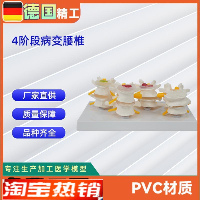 德国】人体4阶段病态腰椎比较模型人体骨骼模型医学教学教具