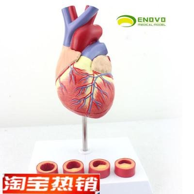 ENOVO颐诺 1:1医学人体心脏模型冠状动脉血栓心内科教学动脉粥样