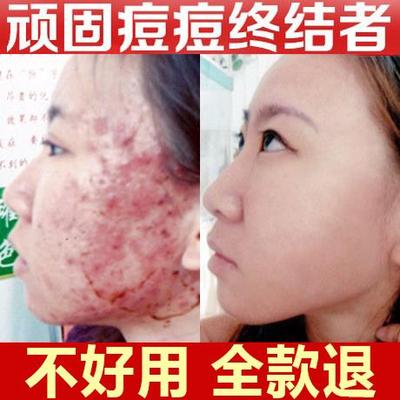 青少年去痘膏祛痘正品青春痘初中生痤疮膏祛痘重度暗疮护肤品神器