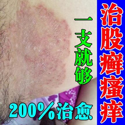 大腿内侧皮肤瘙痒止痒根去男士股藓私处真菌感染红疹疙瘩皮炎杀菌