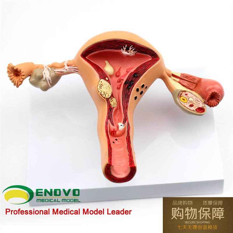 ENOVO颐诺人体女性子宫卵巢模型 子宫疾病生殖科妇产科医患沟通讲