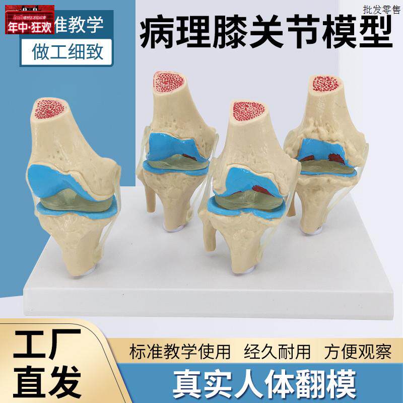人体病理膝关节s模型病变膝关节退行性膝关节/病关节镜手术沟通