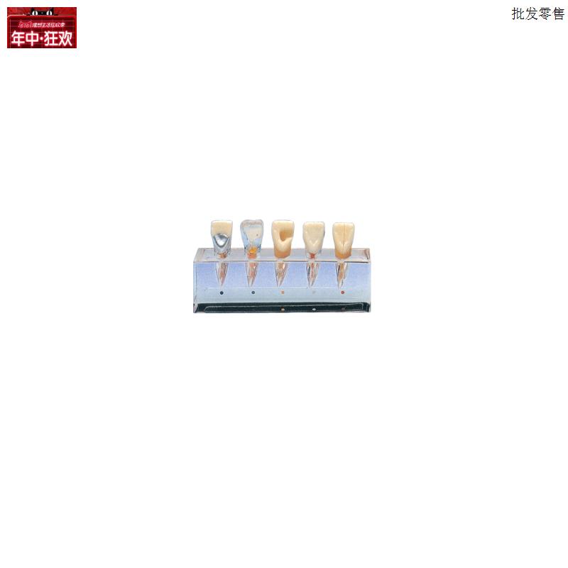 牙齿病变系列模型BX10015/1