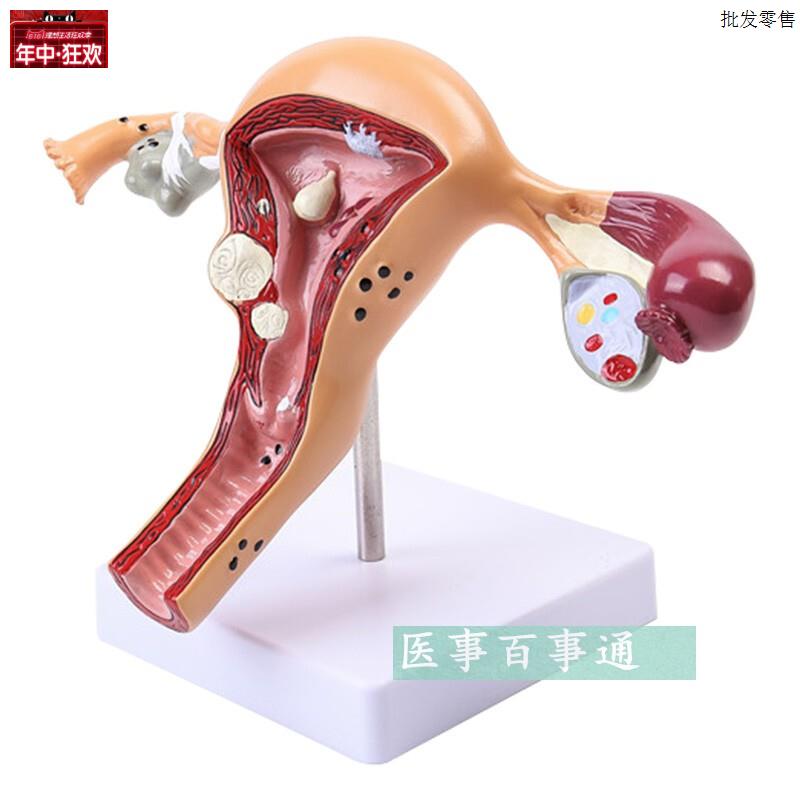 人体子宫模型生殖科妇科医用演示模型女性N子宫阴道模型病理子宫