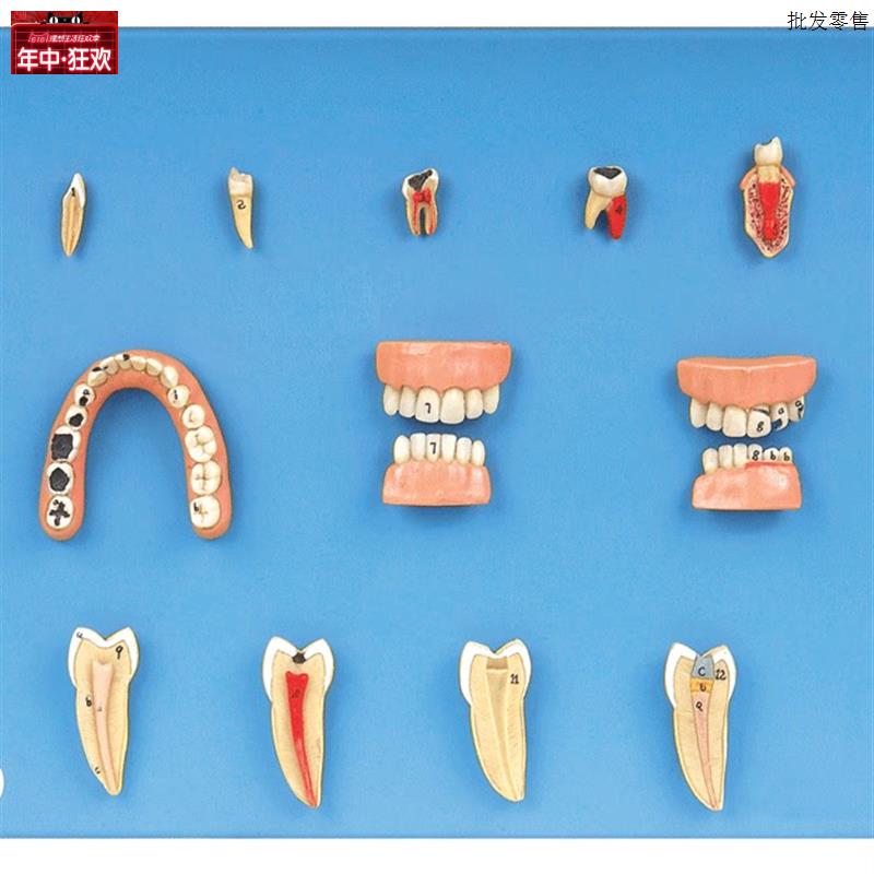 牙齿病变系列模型tB10017