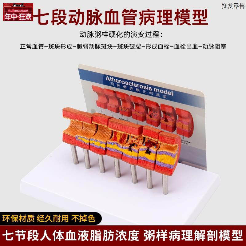 仿真人体心脑血管h动脉粥样硬化堵塞模型血栓血液脂肪病理解剖教