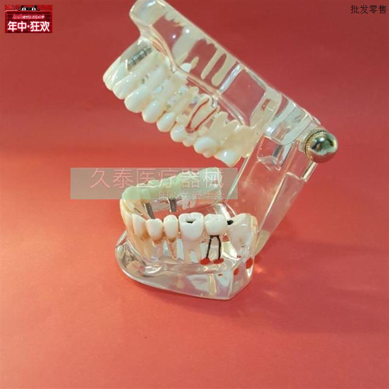 牙齿模型成人透g明病理种植修复模型牙科模型(包邮)口腔模型