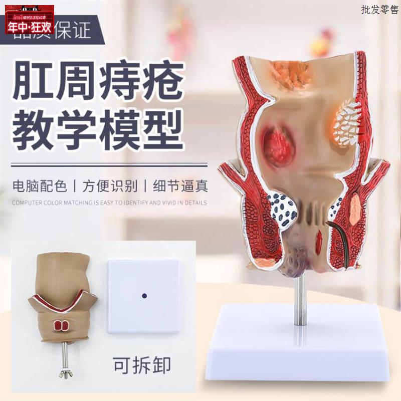 教学彷真人体直肠n和肛门肛肠疾病痔肛娄溃疡性结肠病理痔疮模型