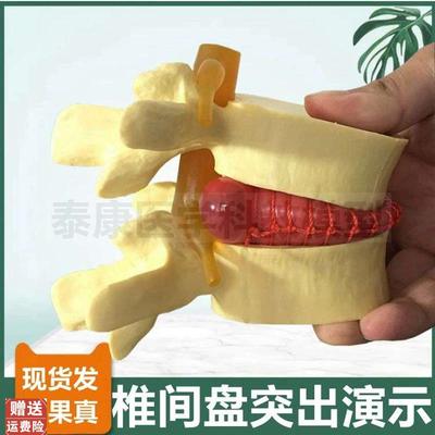 人体腰椎模型椎间盘脊髓神经y椎骨劳损病理突出演示疏松骨密质