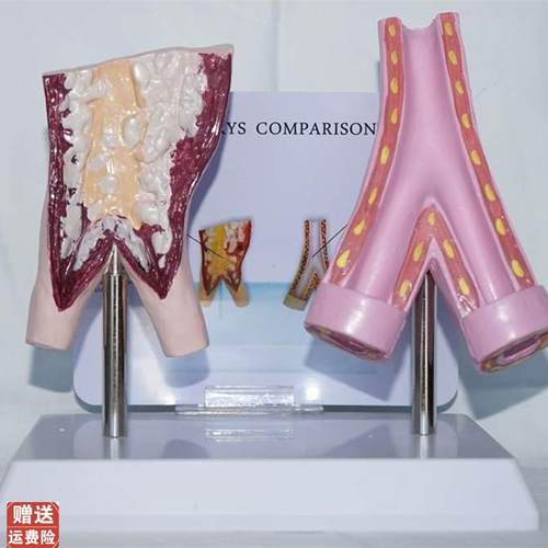 吸烟血管与正常血管比较模型y人体血管病理展示医用教学讲解教具
