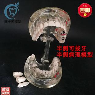 牙科牙齿模型成人病理半侧可拔牙模型医患沟通口腔教.学教具C3