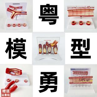动态血管粘稠堵塞模型动s支脉粥样硬化心血管支架放大病理教学模