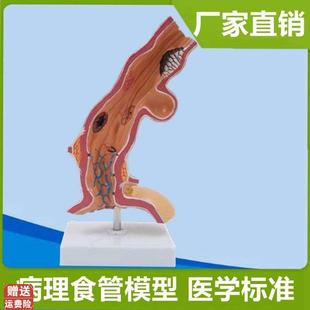 人体食管模型消化道静脉临床医患医药H礼品胃粘膜病理变化瘘道孔