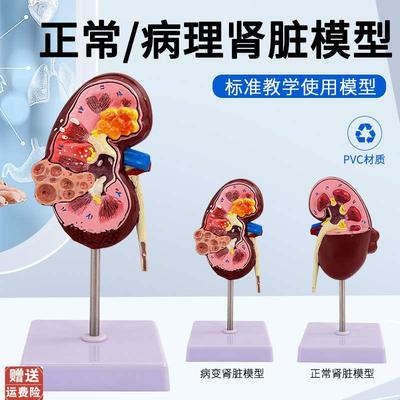 人体病变肾上腺j模型肾脏解剖模型肾模型生殖泌尿科肾病理模型