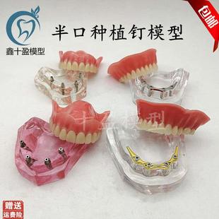 牙科模型医患沟通k2四4颗钉种植与修复模型种植钉球帽杆卡导板