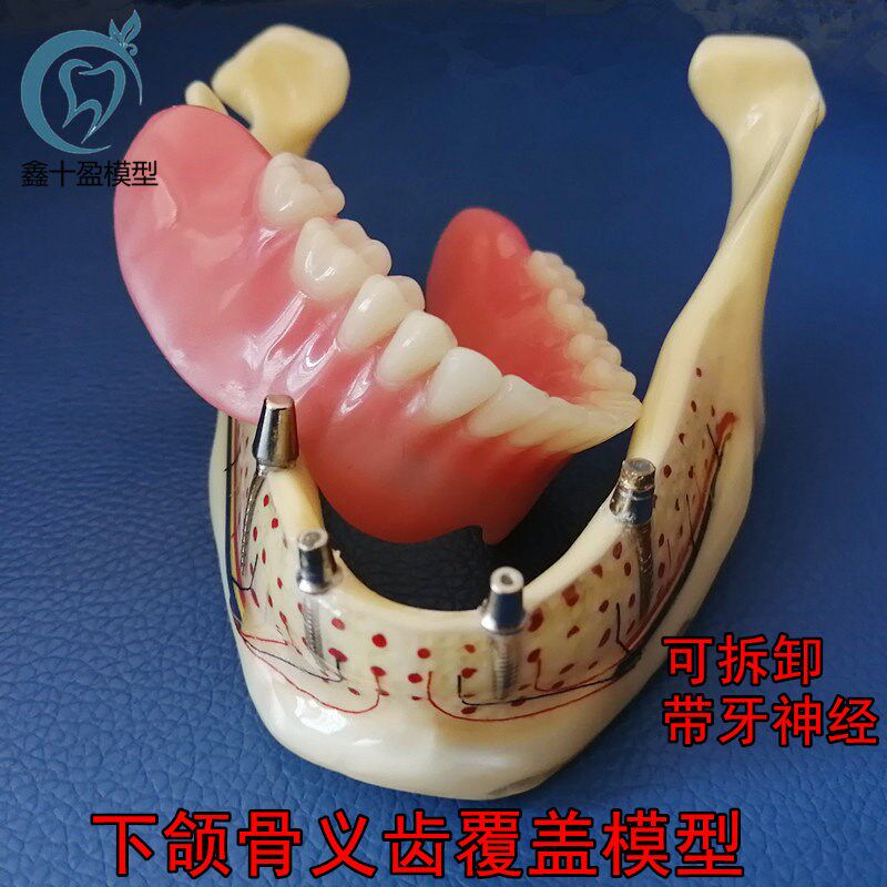 牙科口腔下颌骨展示模型 透明下颌骨展示种植钉 义齿修W复模型600