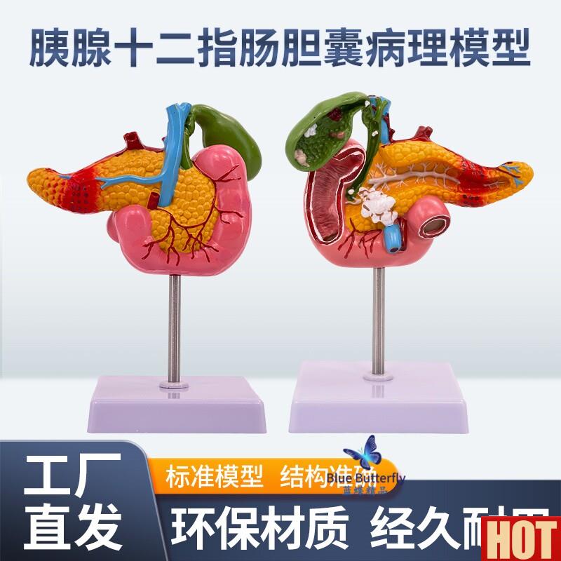 学胰腺十二指M肠胆囊病理模型 胆结石外科消系统肝胆科模型
