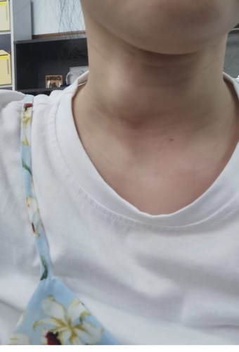 结和节甲状节月市节林巴如腺等结子留子Ca，可缩小可查可验