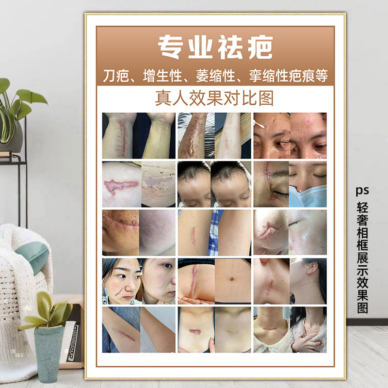 祛疤海报祛斑祛痘广告疤痕修复图