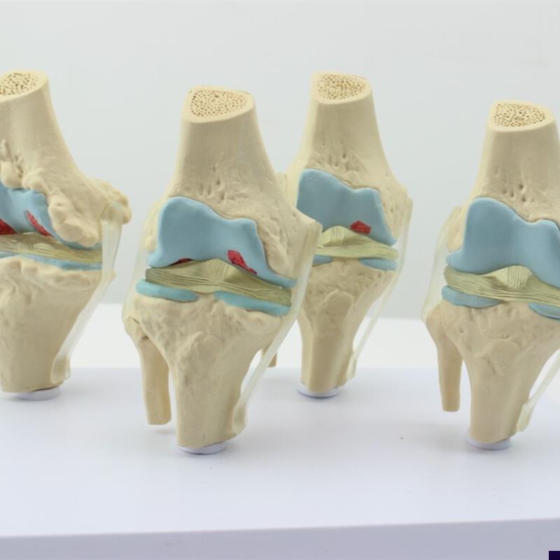 ENOVO颐诺i人体病理膝关节模型退行性血友病模型骨科管骨骼模型膝