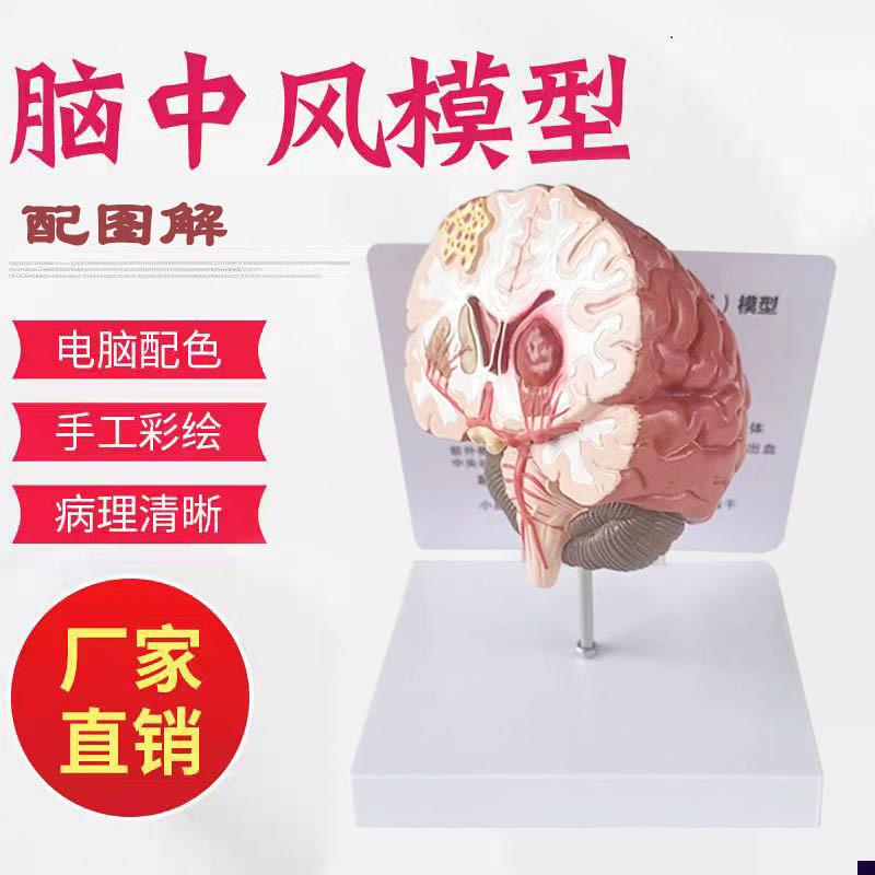 人体脑部疾病模型脑瘀血管u大脑解剖中风脑梗神经外科神经内科模
