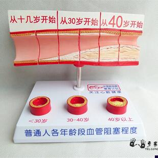 人体支脉粥样h硬化和血栓形成模型人体模型病态血管模型