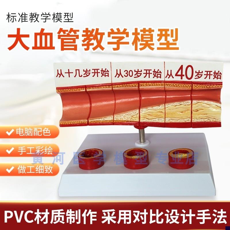 血栓模型人体支脉粥样硬化动脉心血管各阶段年龄Y血管展示模型