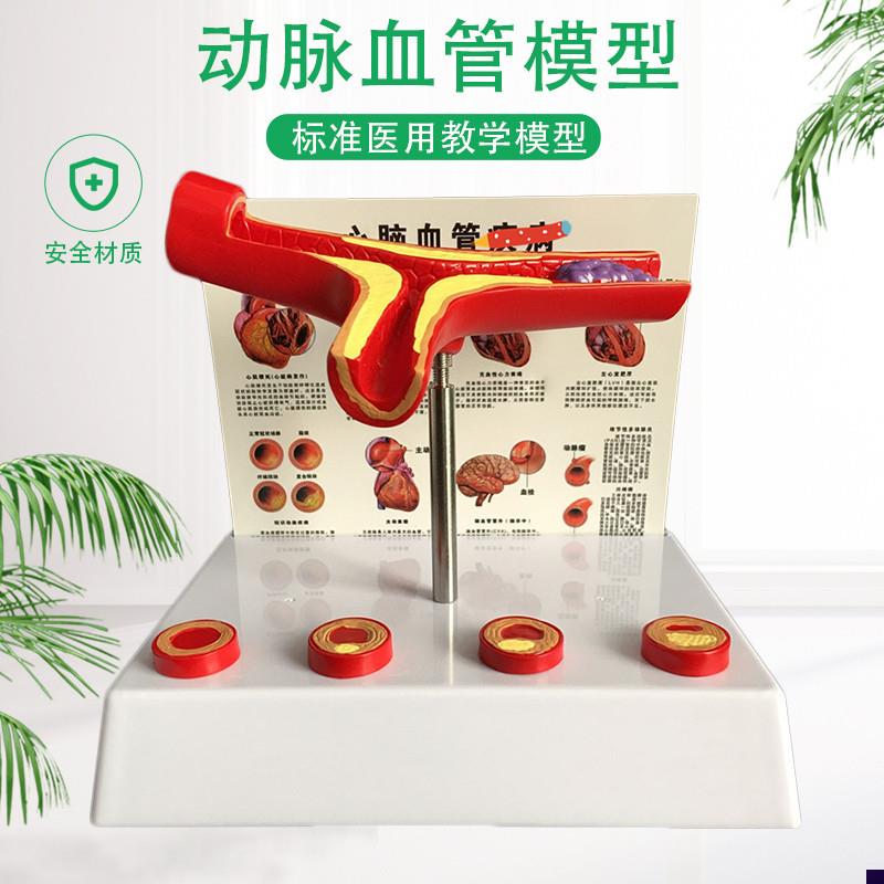 人体支脉粥样11硬化心血管动脉1解剖模M型血栓模型人体血管模型