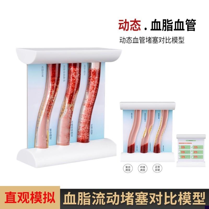 血管浓稠度堵h塞对比人体血脂斑块血栓展示模具仿真动态血管模型