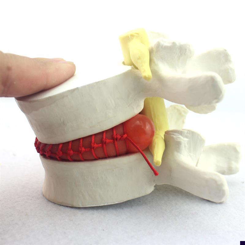 颐诺正品医用人体腰椎间盘突出演示模型腰椎Q模型骨科脊柱模型