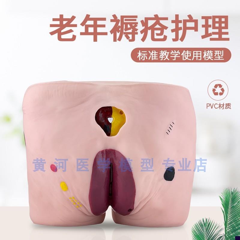 教学模型医院培训老年人褥疮护理模型压疮护理模V型养老护理训练